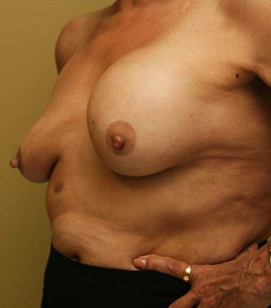 Breast Augmentation