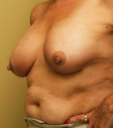 Breast Augmentation