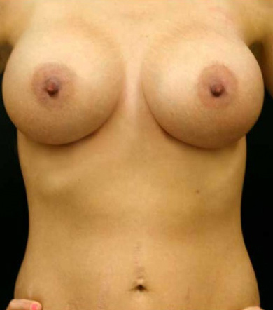 Breast Augmentation