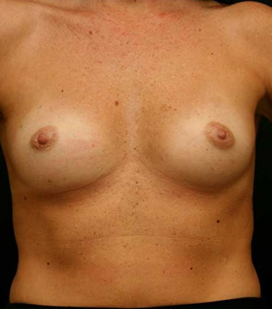 Breast Augmentation