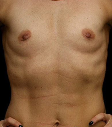 Breast Augmentation