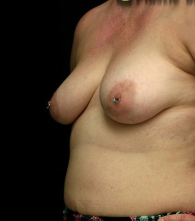 Breast Augmentation