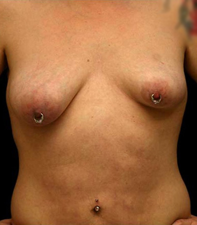 Breast Lift