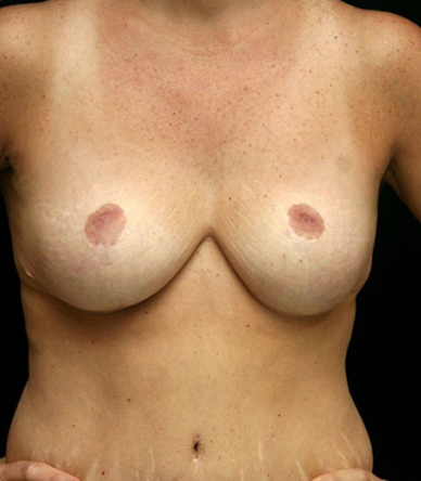 Breast Lift