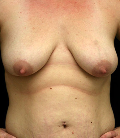 Breast Lift
