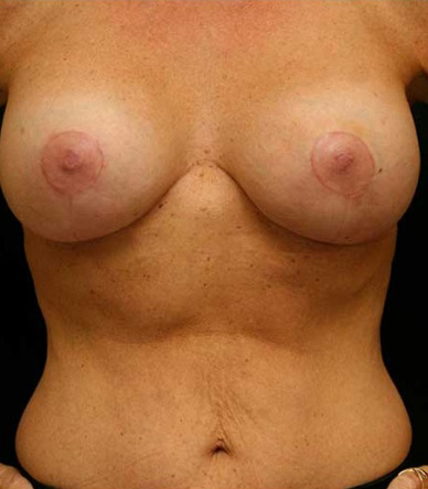 Breast Lift