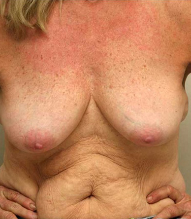 Breast Lift