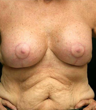 Breast Lift