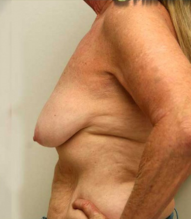 Breast Lift