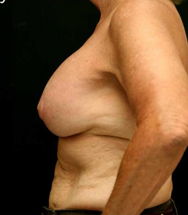 Breast Lift