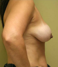 Breast Lift