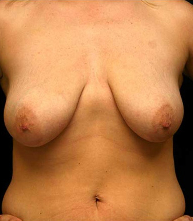 Breast Lift