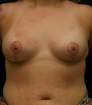 Breast Lift