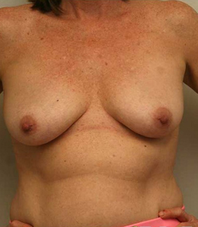 Breast Lift
