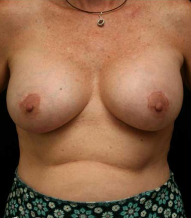 Breast Lift