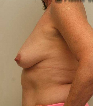 Breast Lift