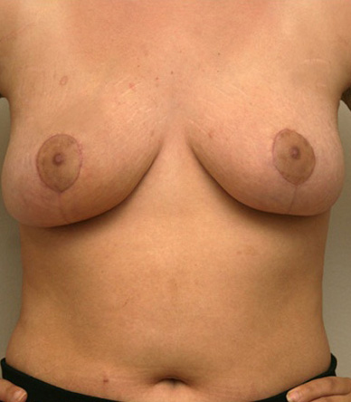 Breast Lift