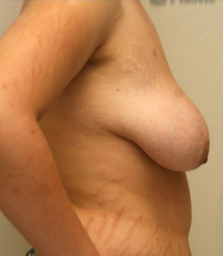Breast Lift