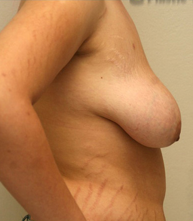 Breast Lift