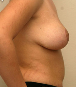 Breast Lift