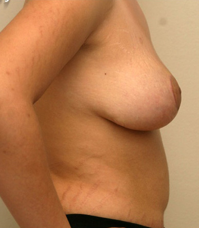 Breast Lift