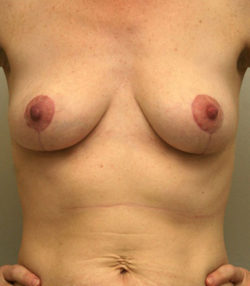 Breast Lift