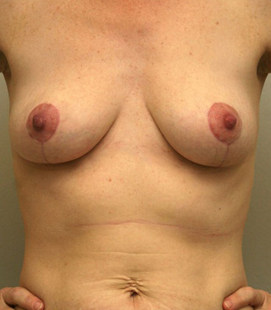 Breast Lift
