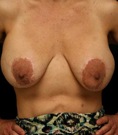 Breast Lift