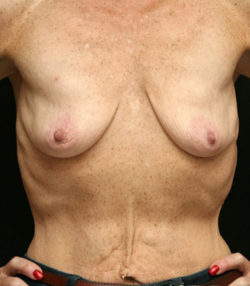 Breast Lift
