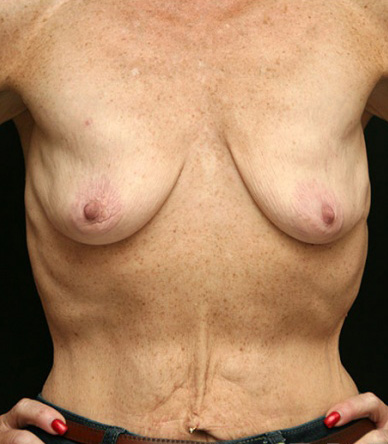 Breast Lift