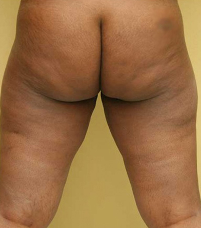 Thigh Lift