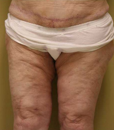 Thigh Lift