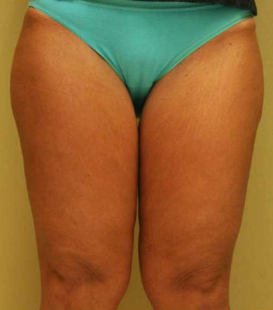 Thigh Lift