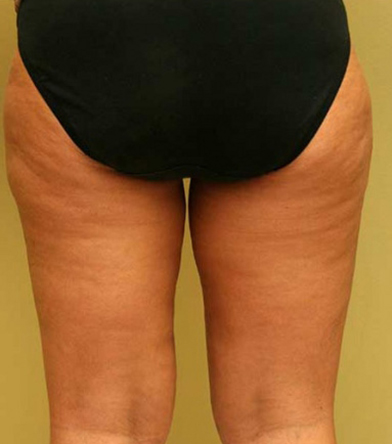 Thigh Lift