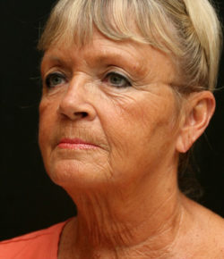 Face and Neck Lift