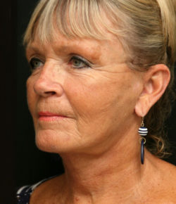 Face and Neck Lift