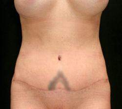 Tummy Tuck