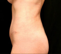 Tummy Tuck