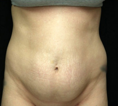 Tummy Tuck