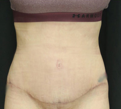 Tummy Tuck