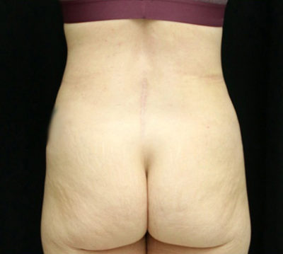 Tummy Tuck