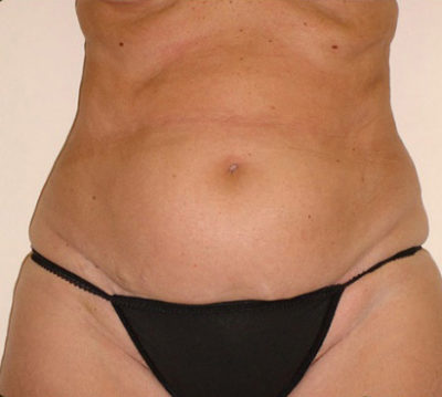 Tummy Tuck
