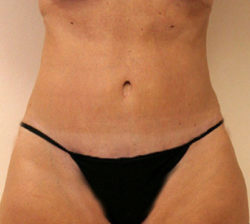 Tummy Tuck