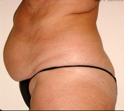 Tummy Tuck
