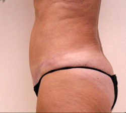 Tummy Tuck