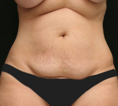Tummy Tuck