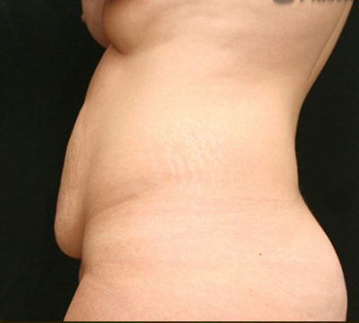 Tummy Tuck