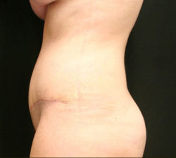 Tummy Tuck