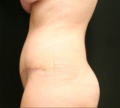 Tummy Tuck