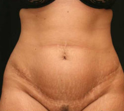 Tummy Tuck